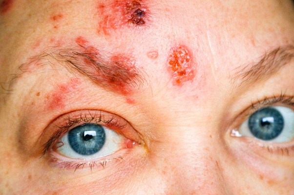 Shingles risk increases after 50 – are you aware?